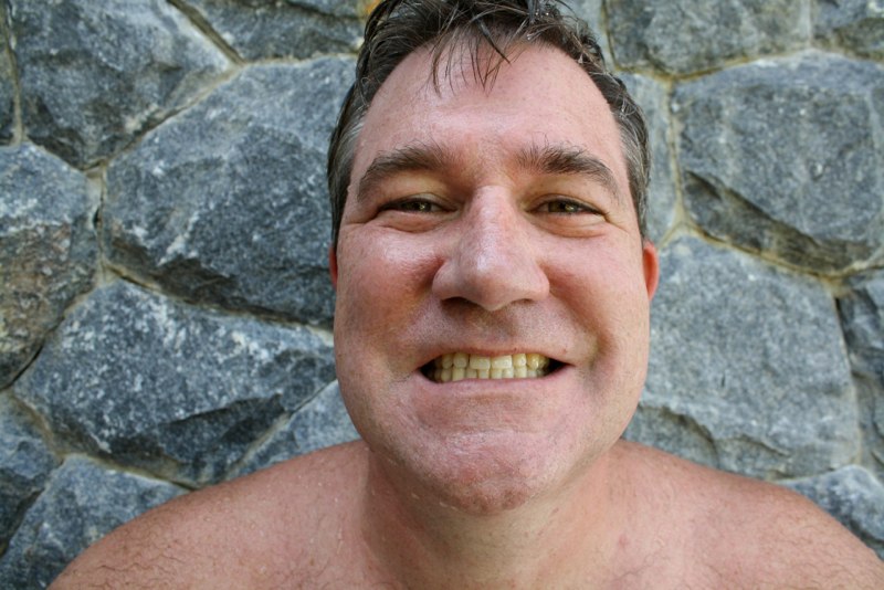 Pat’s teeth BEFORE bleaching